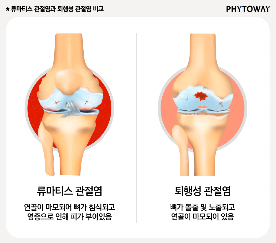 관절염 증상, 원인과 퇴행성관절염 vs 류마티스관절염 비교 / 관절염에 좋은 음식, 관절염 영양제 추천!