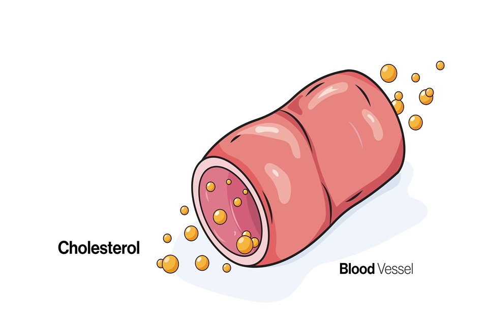 HDL 콜레스테롤 낮으면 생기는 문제들